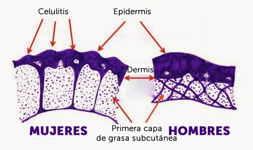 celulitis-piel